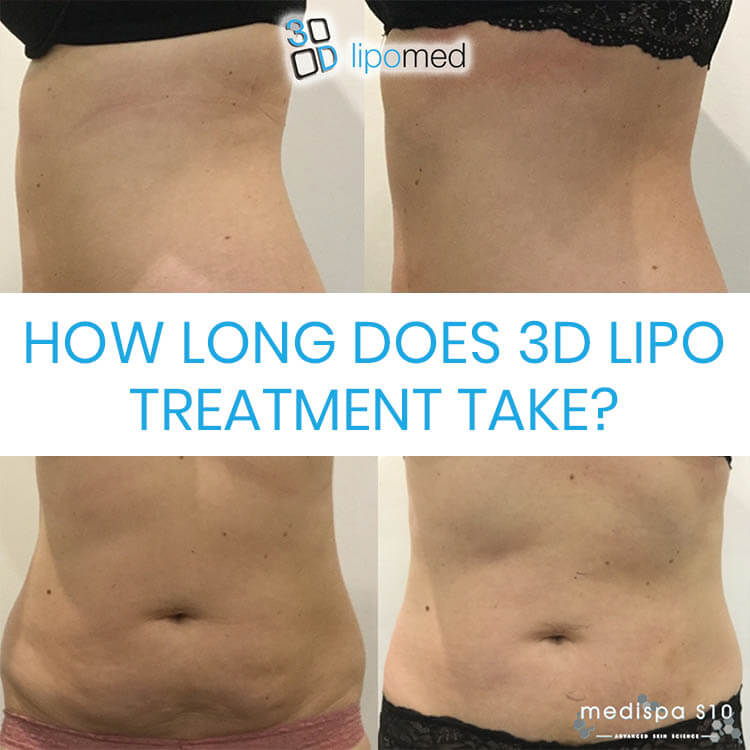 How long does 3D Lipo treatment take adn what to expect?